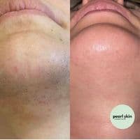 Pearl Skin Cosmetics Dresden - Laser Haarentfernung | HydraFacial | Microneedling